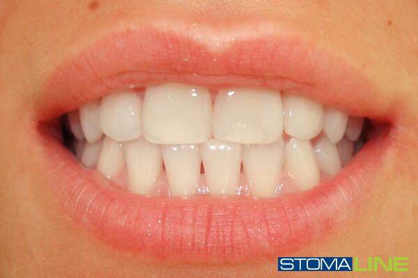 Фото2 зубов после лечения